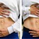 Diastasis Recti Before and After